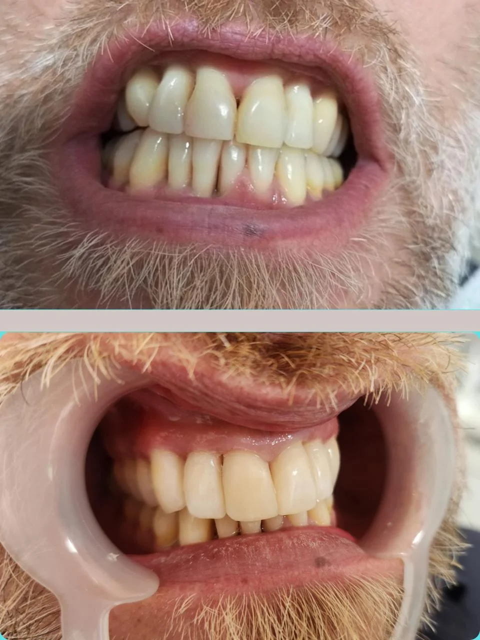 Before and after: scale and polish